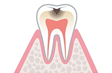 C2（中程度の虫歯）のイメージ