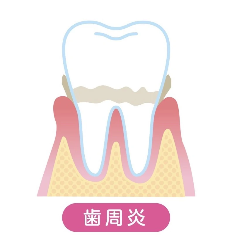 歯肉炎（初期段階）のイメージ