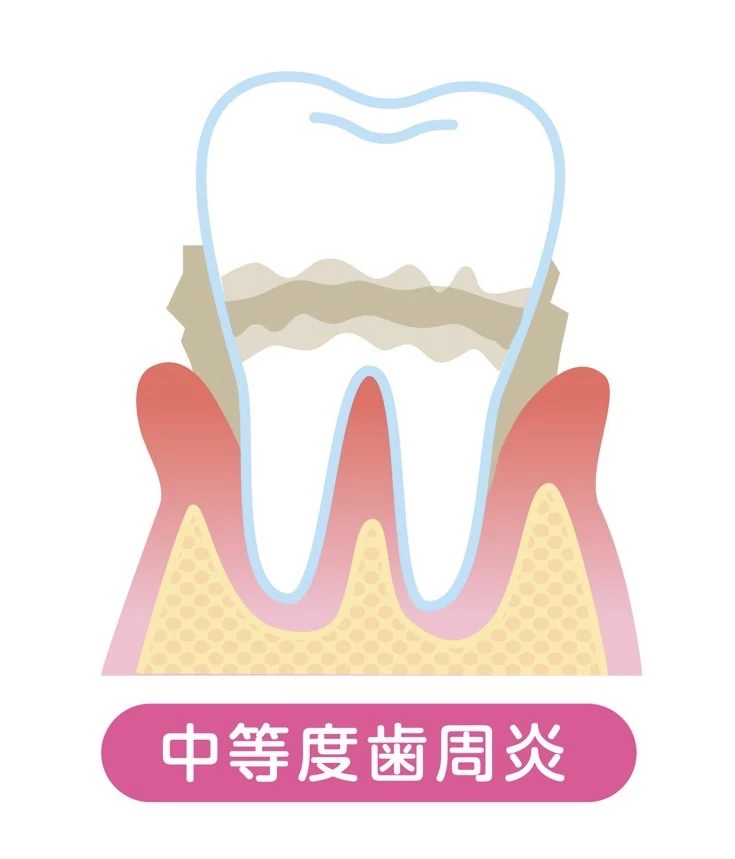 軽度〜中等度歯周炎のイメージ