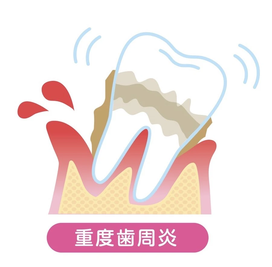 重度歯周炎のイメージ